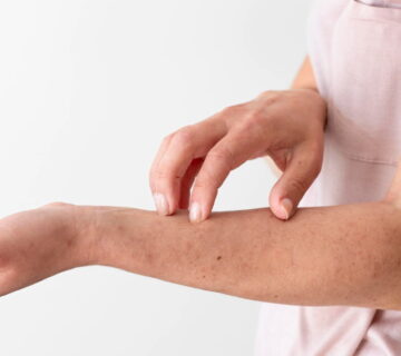Fleabites Symptoms. How Do You Tell If A Bite Is From A Flea